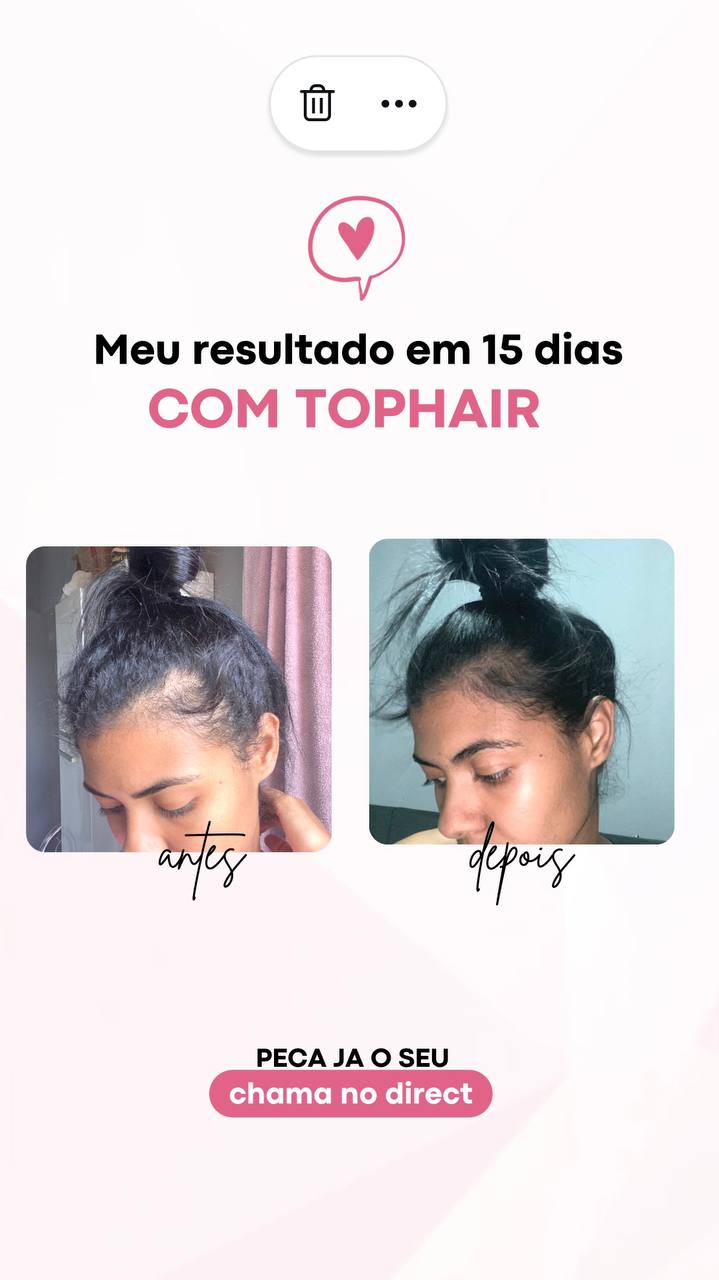 Combate à Queda de Cabelo - Mulheres e Homens em Adolfo, SP.